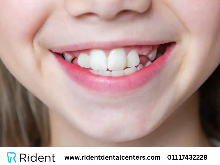 أسنان الأطفال